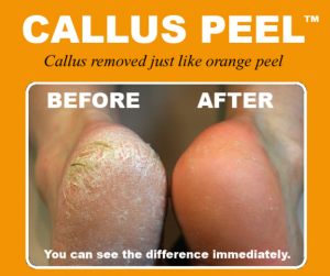 Callus Peel